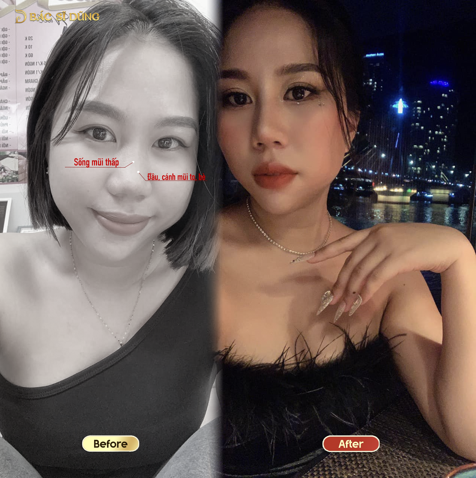 Ưu điểm vượt trội của nâng mũi MonoPod